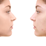 before and after face treatment