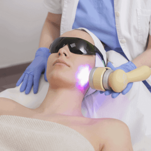 IPL Treatment