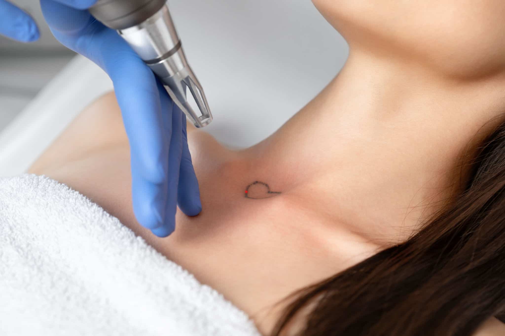 Cosmetic Tattoo and Removals 2