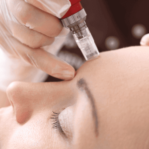 Skin Needling (Mesotherapy)