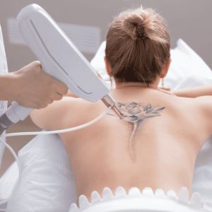 Skinial Tattoo Removal Hornsby