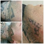 skinial tattoo removal