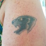 tattoo removal 2