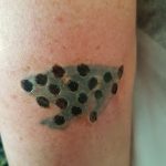 skinial tattoo removal 2