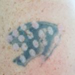 tattoo removal in Hornsby