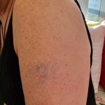 Hornsby tattoo removal