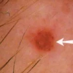 Cherry Angioma image