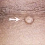 Flat Skin Tag image