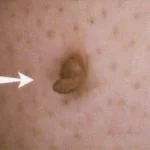 Skin Tag Stalk image