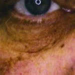 Skin Tag Eye image 2