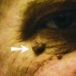 Skin Tag Eye image